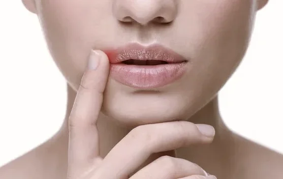 Cara Tepat Mengatasi Bibir Kering dan Pecah-Pecah