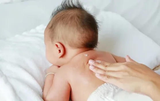 Kenali Masalah Kulit Bayi dan Cara Mengatasinya