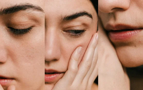 Mengenal 'Cortisol Face', Efek Nyata Stres Kronis pada Kulit