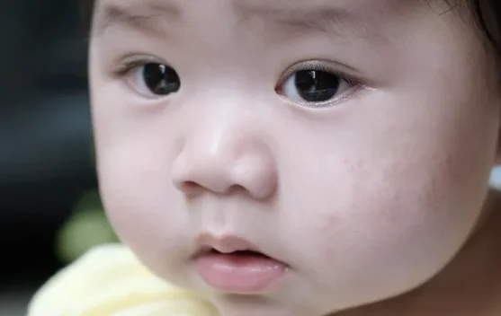 Kenali Pitiriasis Alba Penyebab Bercak Putih pada Anak