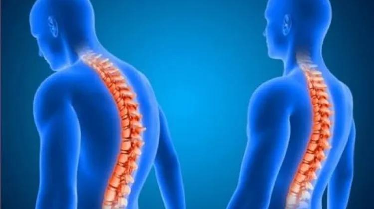 Kenali Kelainan Tulang yang Diam Diam  Mengancam Tubuh