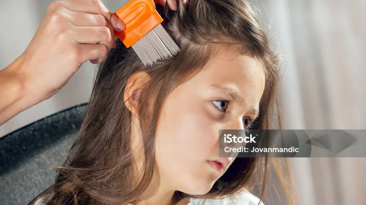 Dari Mana Datangnya Kutu di Rambut? Ini Penjelasannya