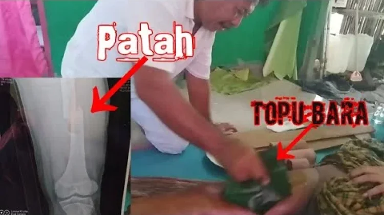 Mengenal pengobatan tradisional pukul bara dari maluku