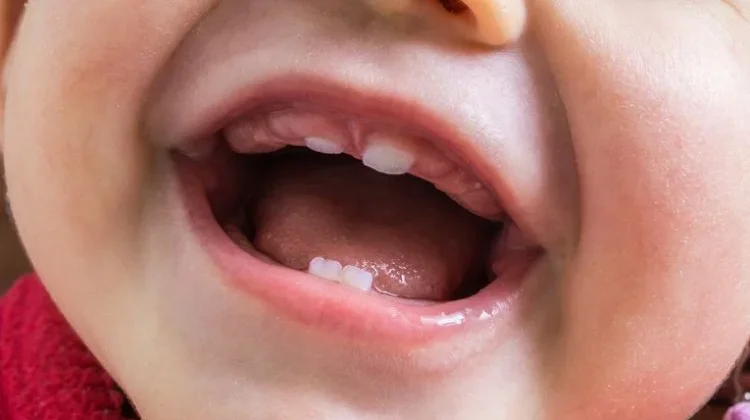 Baby Bottle Tooth Decay, Ancaman Tersembunyi di Balik Kebiasaan Minum Susu dari Bot