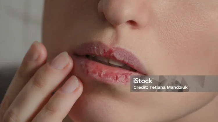 Penyebab Bibir Pecah-Pecah yang Sering Diabaikan
