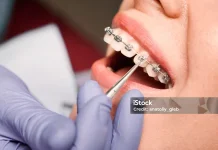 Tips Aman Menggunakan Behel Gigi Agar Tetap Nyaman