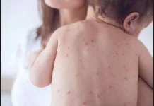 Kenali Gejala Campak pada Anak: Mulai dari Demam Tinggi, Mata Merah, hingga Munculnya