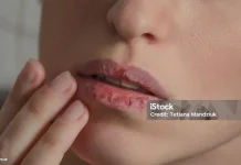 Penyebab Bibir Pecah-Pecah yang Sering Diabaikan