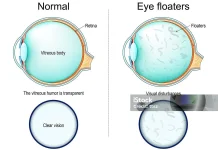 Kenali Bahaya Floaters yang Muncul di Penglihatan