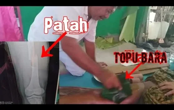 Mengenal pengobatan tradisional pukul bara dari maluku