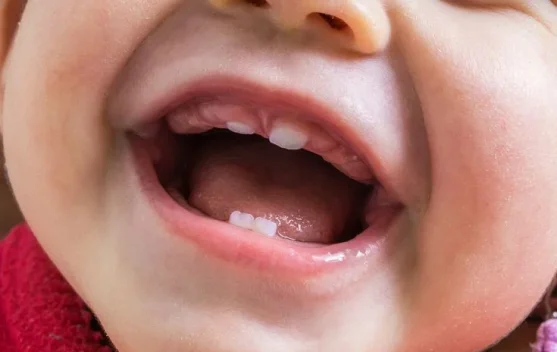 Baby Bottle Tooth Decay, Ancaman Tersembunyi di Balik Kebiasaan Minum Susu dari Bot