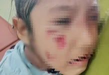 Siswi di Bima Jadi Korban Gigitan Anjing Rabies