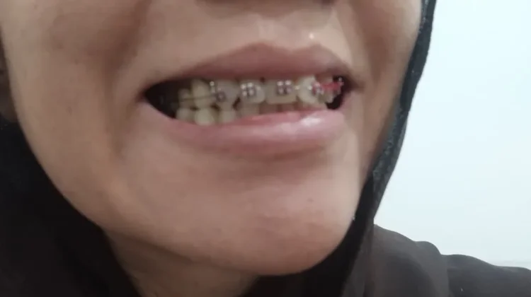 Penggunaan Behel Bikin Senyum Tampak Lebih Simetris