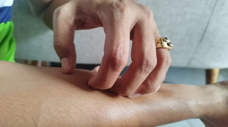 Berikut Penyebab dan Cara Mengatasi Gatal karena Alergi