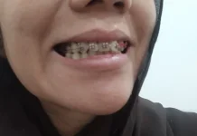 Penggunaan Behel Bikin Senyum Tampak Lebih Simetris