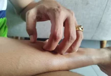 Berikut Penyebab dan Cara Mengatasi Gatal karena Alergi