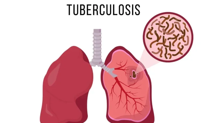 Tanggal 24 Maret Diperingati Hari Tuberkulosis, Ini Sejarahnya