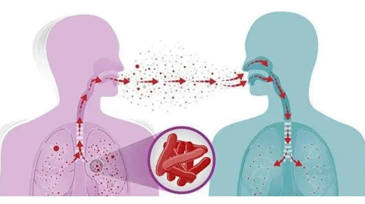 Tuberkulosis, Ketahui Penyebab dan Gejala serta Pencegahannya