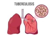 Tanggal 24 Maret Diperingati Hari Tuberkulosis, Ini Sejarahnya