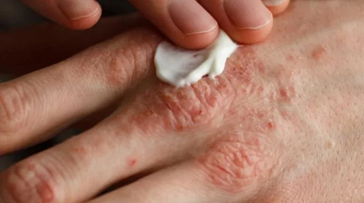 Psoriasis: Penyakit Kulit Kronis, Ini Faktor Penyebab dan Terapi