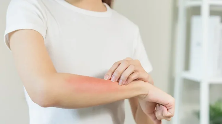 Jangan Panik, Begini Cara Menangani Luka Bakar akibat Air Panas