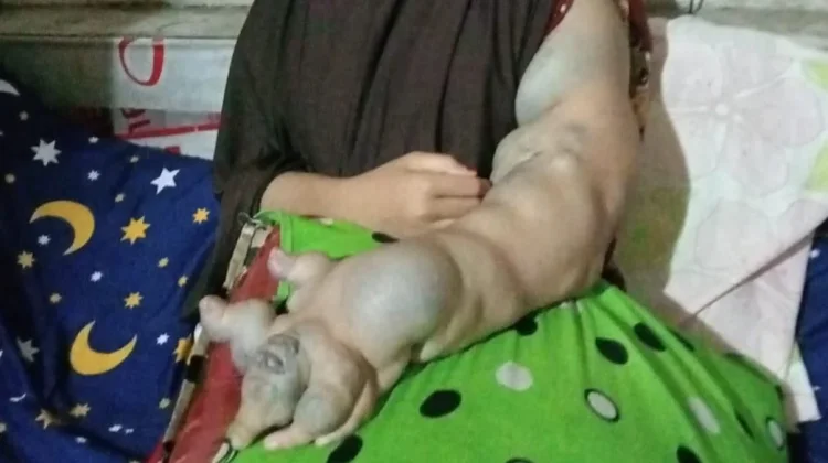 Open Donasi Kemanusiaan, Adik Wartawan Aceh Barat Berjuang Melawan Tumor