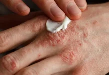 Psoriasis: Penyakit Kulit Kronis, Ini Faktor Penyebab dan Terapi