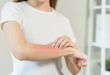 Jangan Panik, Begini Cara Menangani Luka Bakar akibat Air Panas