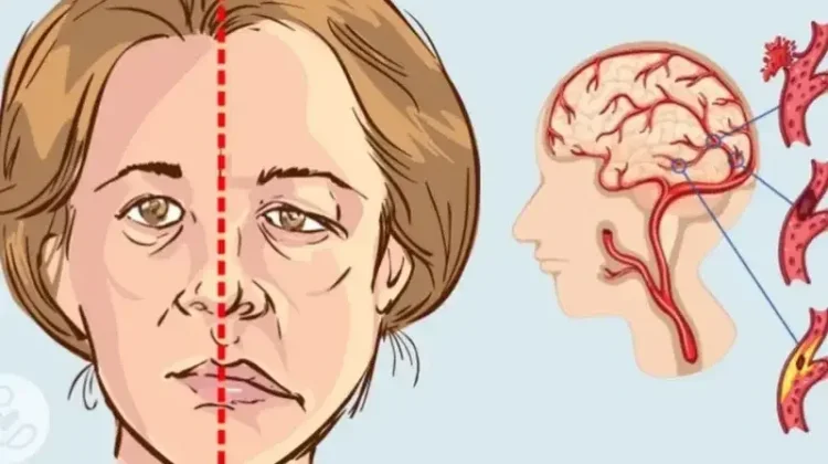 Kenali Gejala Stroke dan Cara Penanganan Awal