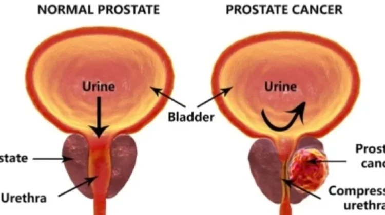 Menjaga Kesehatan Prostat sejak Usia Muda