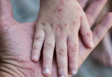 Mengenal Campak: Penyakit Menular yang Perlu Diwaspadai