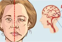 Kenali Gejala Stroke dan Cara Penanganan Awal