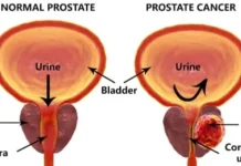 Menjaga Kesehatan Prostat sejak Usia Muda