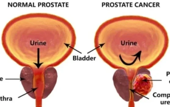 Menjaga Kesehatan Prostat sejak Usia Muda