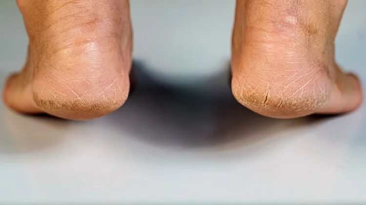 Haluskan Tumit Kasar dengan Bahan Alami ini