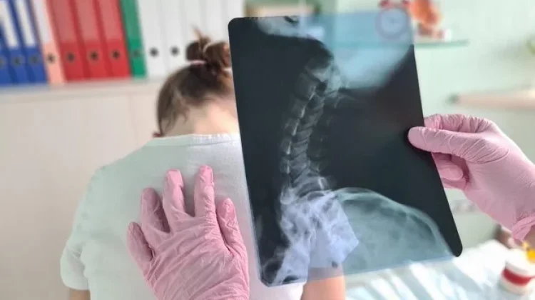 Waspada Osteosarkoma, Kanker Tulang yang Rentan Serang Remaja