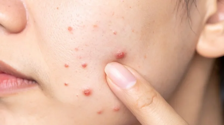 Cara Ampuh Mengobati Jerawat dengan Bahan Alami