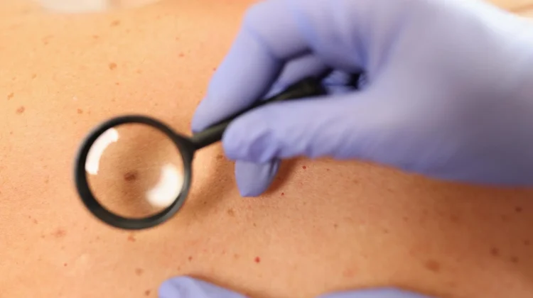 Bahaya Penyakit Melanoma pada Anak