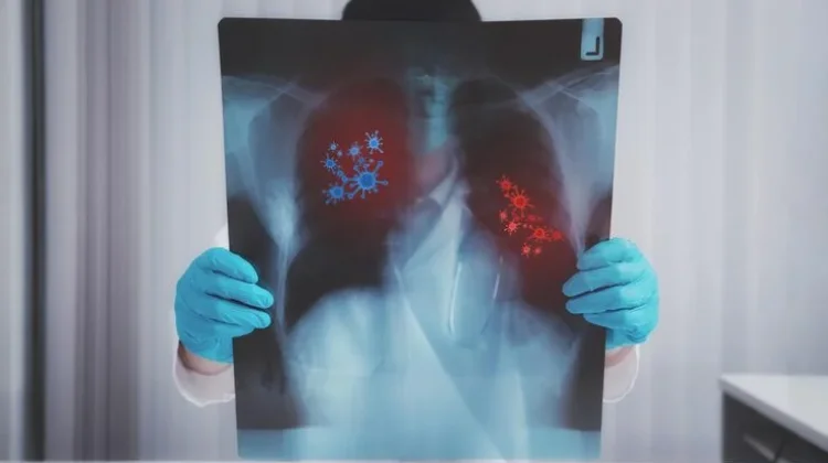 Cegah Tuberkulosis atau TBC Dimulai Dari Diri Sendiri