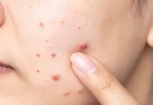 Cara Ampuh Mengobati Jerawat dengan Bahan Alami