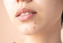 Stres Berlebih Picu Jerawat Hormonal pada Wajah