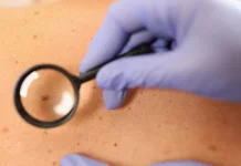 Bahaya Penyakit Melanoma pada Anak