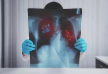 Cegah Tuberkulosis atau TBC Dimulai Dari Diri Sendiri
