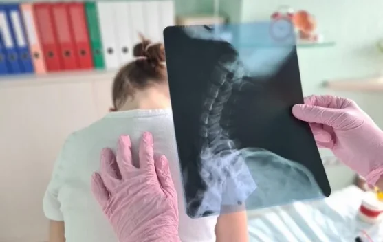 Waspada Osteosarkoma, Kanker Tulang yang Rentan Serang Remaja