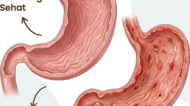 Cara Cepat Meredakan asam Lambung Naik