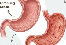 Cara Cepat Meredakan asam Lambung Naik