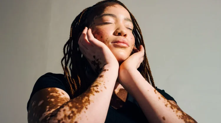 Hari Vitiligo Sedunia 2026, Dorong Kepedulian dan Penghapusan Stigma Global