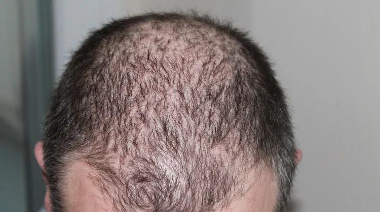 Penyebab Rambut Menipis pada Pria, Ketahui Cara Mengatasinya