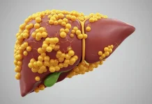 Mengenal Fatty Liver, Penyakit Hati Berlemak yang Sering Tidak Disadari