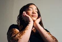 Hari Vitiligo Sedunia 2026, Dorong Kepedulian dan Penghapusan Stigma Global